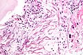 Pulmonary aspergillosis