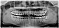 Impacted wisdom teeth