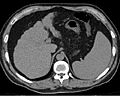 Liver cirrhosis