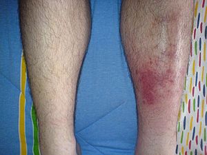 Cellulitis1