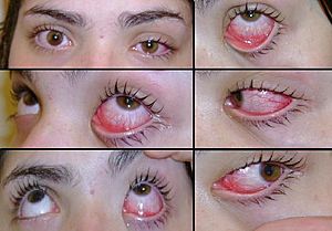 Example of conjunctivitis