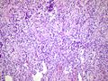 Suppurative epidydimo orchitis histopathology