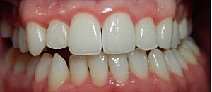 Gingivitis-after