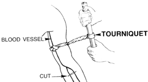 Tourniquet (PSF)