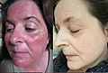 Steroid Rosacea