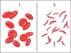 Sickle cell anemia