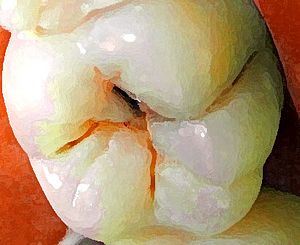 Dental caries