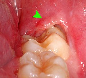 38 pericoronitis with pus