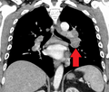 HilarAdenopathyCCor