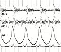 Phonocardiogram