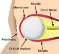 Prosthetic eye