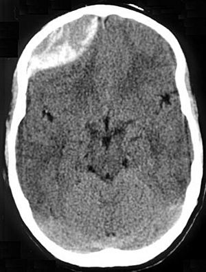 Traumatic acute epidual hematoma