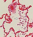 Histopathology of pulmonary congestion and siderophages