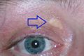 Xanthelasma palpebrarum