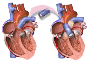 Ross Procedure