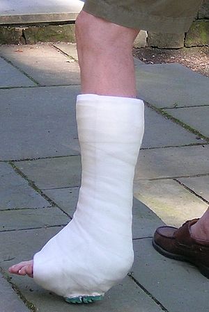 Short Leg Walking Cast