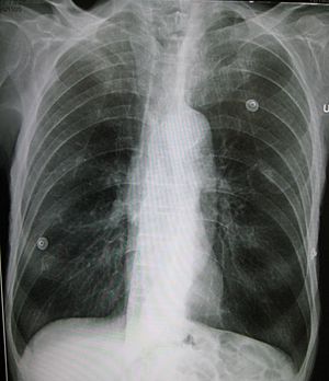 Emphysema2008