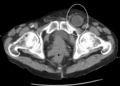 Inquinalhernia