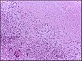 Tuberculous lymph node with caseating granuloma 40X