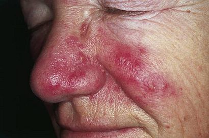 Rosacea.jpg