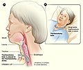 Tracheostomy NIH