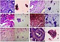 Endometrial histopathologies and cytopathologies