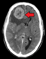 MetstoBrain(LungPri)Mark