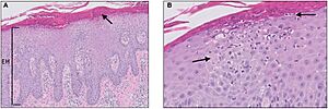 Micrograph of psoriasis vulgaris