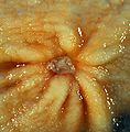 Benign gastric ulcer 1