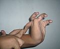 Hypermobility-10