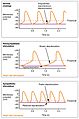 2033 Depolarization in Sinus Rhythm