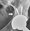 Intraoperative acetabular fracture, annotated