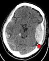 EpiduralHematoma