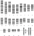 Down Syndrome karyotype