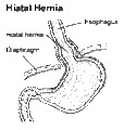 Hiatalhernia