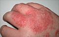 Dermatitis